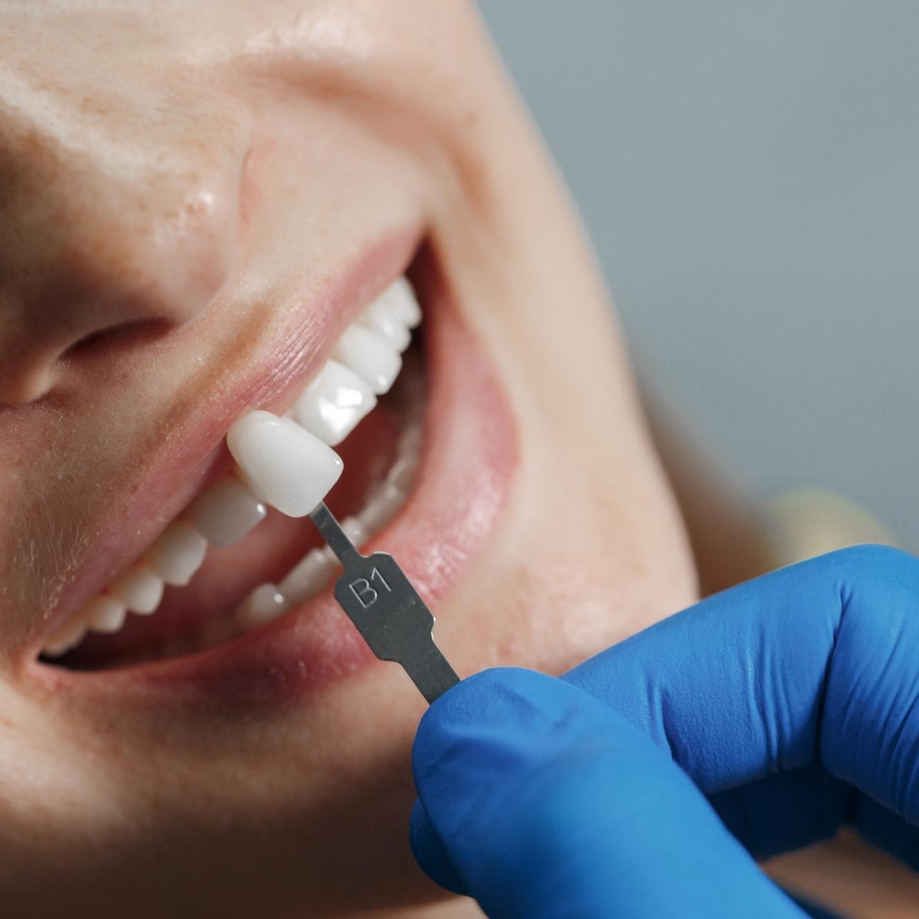 dentist-whiting-teeth dentist-whiting-teeth